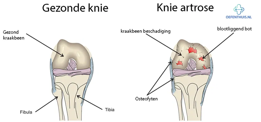 blog_hoe-kies-ik-een-effectieve-kniebrace-bij-artrose_1