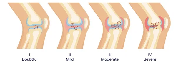 artrose-brace-een-versleten-knie-2