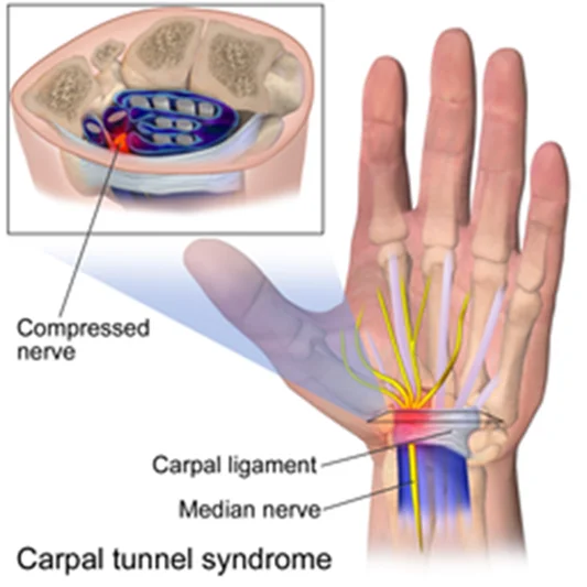 wat-is-het-carpaaltunnelsyndroom-2